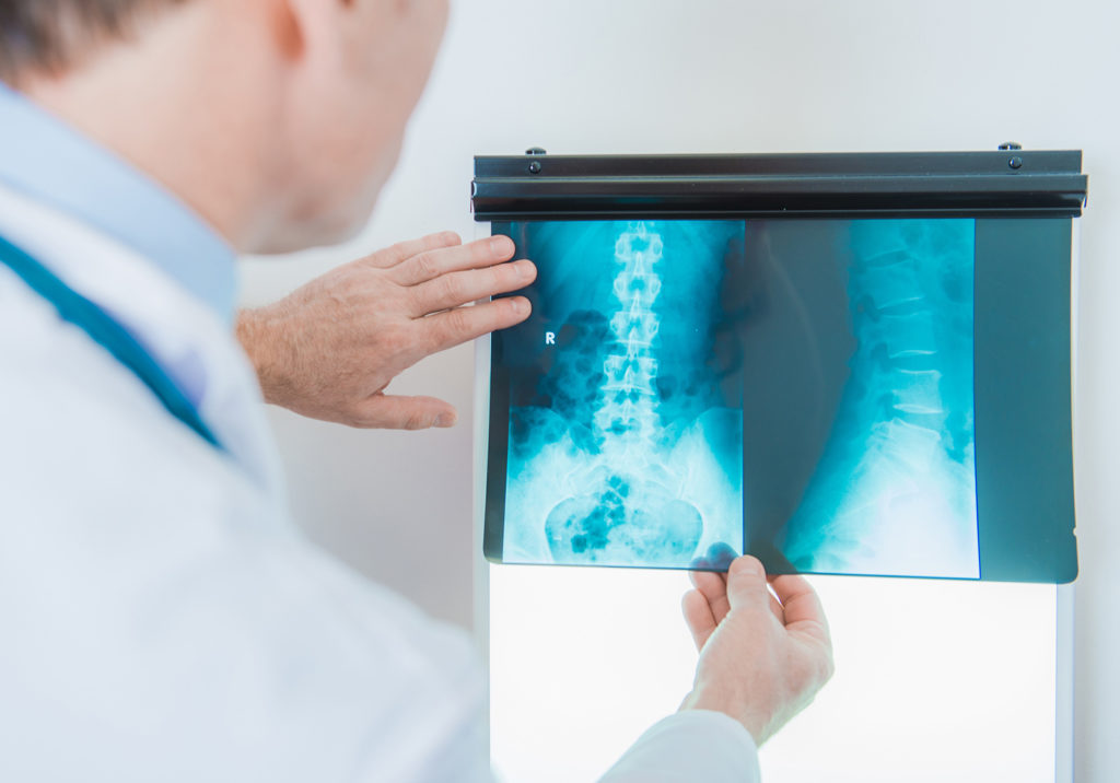 Perth-Wellness-Centre-Blog-What-are-Stress-Fractures