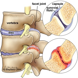 Perth Wellness Centre Blog - What is Facet Syndrome