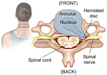 Perth Wellness Centre Blogs - How to treat a Herniated Disc